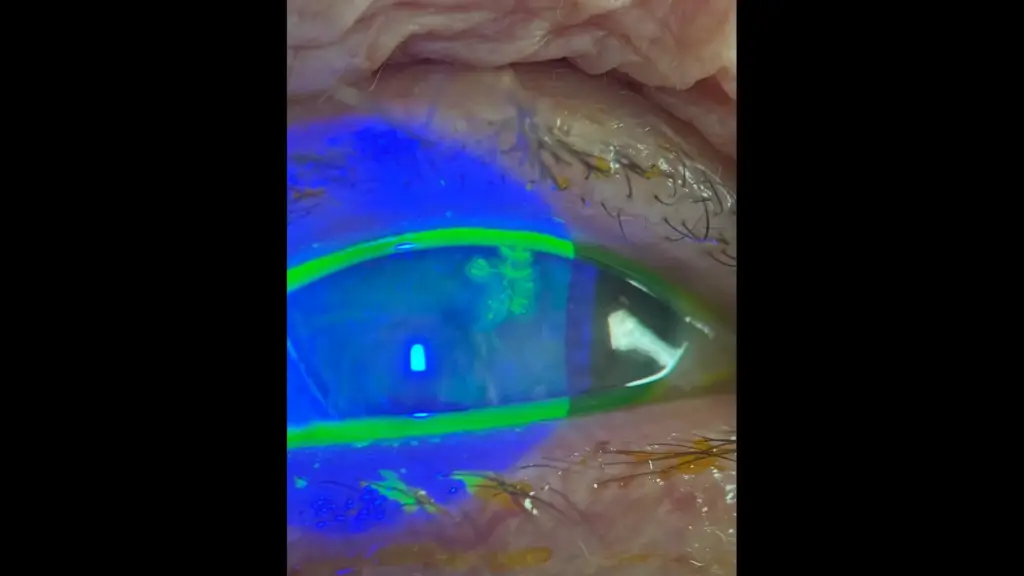 Φυσαλιδώδες εξάνθημα και οίδημα βλεφάρων από οφθαλμικό έρπη - Νεκτάριος Δαμίγος Πειραιάς