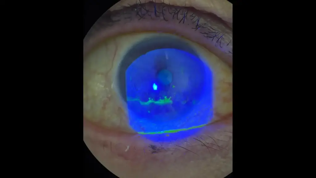 Δενδριτικό έλκος κερατοειδούς με χρώση φλουορεσκεΐνης και μπλε φωτισμό - Οφθαλμικός έρπης Πειραιάς