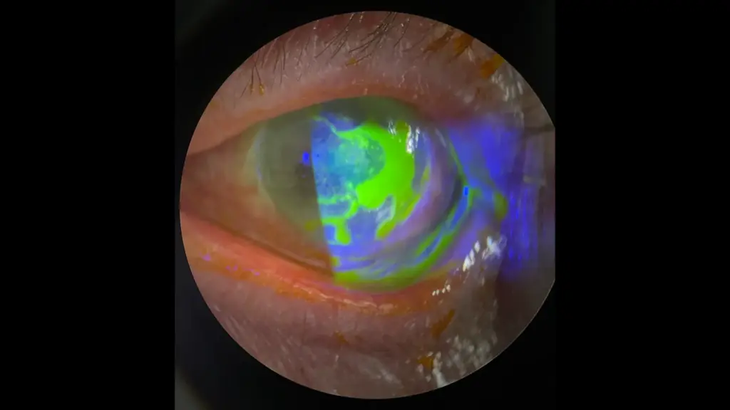 Γεωγραφικό έλκος κερατοειδή σε επαναπροσβολή από οφθαλμικό έρπη - Νεκτάριος Δαμίγος Πειραιάς