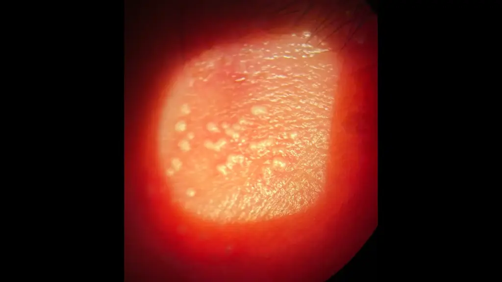 Φυσαλιδώδες εξάνθημα κάτω βλεφάρου με ερυθρότητα και οίδημα - Οφθαλμικός έρπης Πειραιάς - Δαμίγος Νεκτάριος